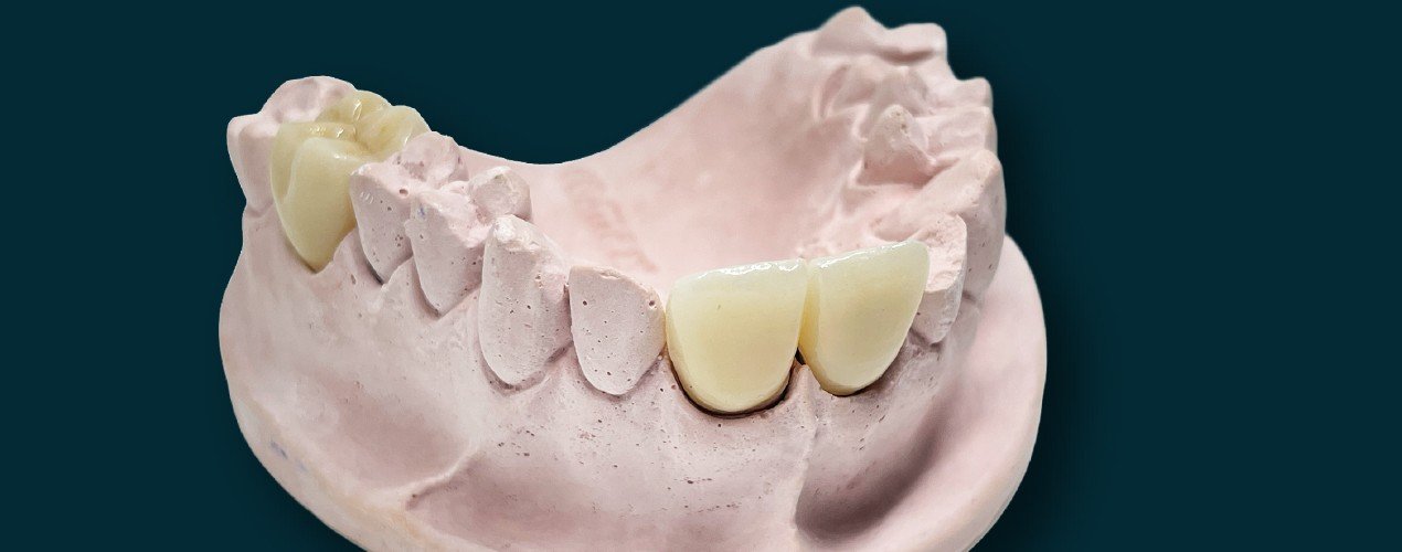 Corona de zirconio sobre modelo de yeso